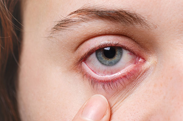 Enfermedades infeccionas del ojo